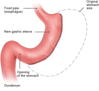 Illustration: Gastric sleeve surgery (sleeve gastrectomy)