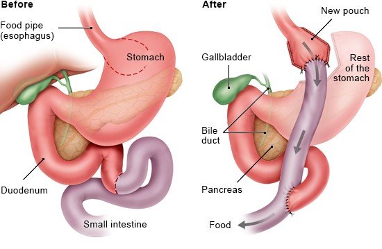 Illustration: Roux-en-Y gastric bypass