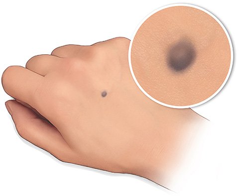 Illustration: A blue nevus (Nevus coeruleus)