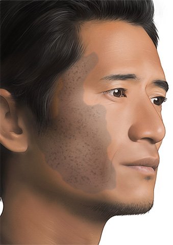 Illustration: A nevus of Ota