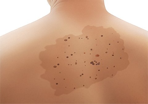 Illustration: A nevus spilus