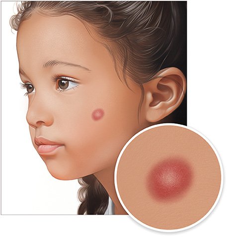 Illustration: A Spitz nevus