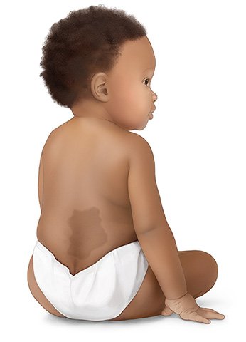 Illustration: A slate gray nevus on a baby