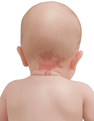 Illustration: Child with nevus flammeus on the back of their neck (stork bite)