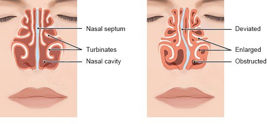 Illustration: Straight and s-shaped nasal septum
