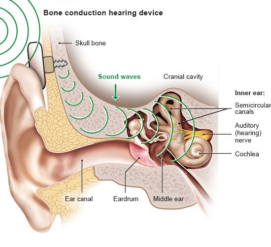 Illustration: Bone-anchored hearing aid