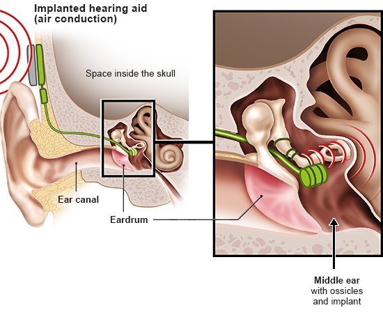 Illustration: Middle ear implant