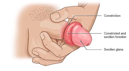 Illustration: Paraphimosis: The blood supply to the glans and part of the foreskin is restricted