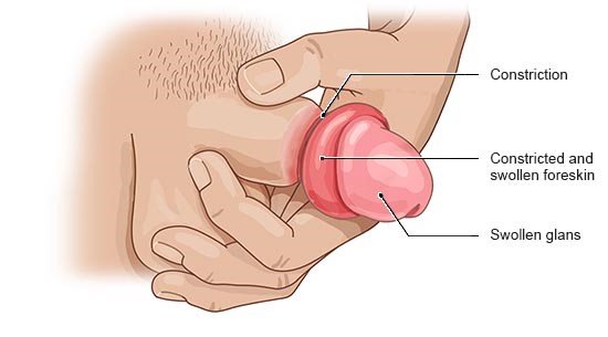 Your guide to foreskin pain and problems