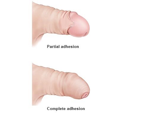 Illustration: Phimosis: Partial and complete adhesion between foreskin and head of the penis (glans) – as described in the article