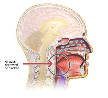 Illustration: Obstructive sleep apnea – as described in the article