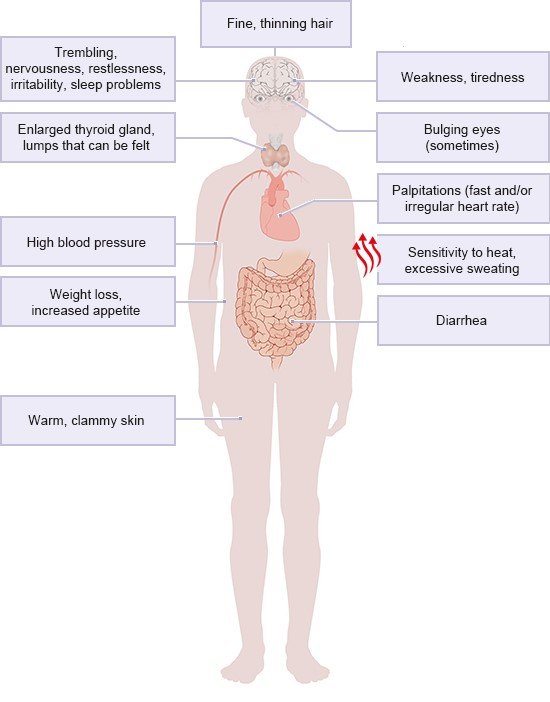 Illustration: An overactive thyroid gland can cause many different symptoms