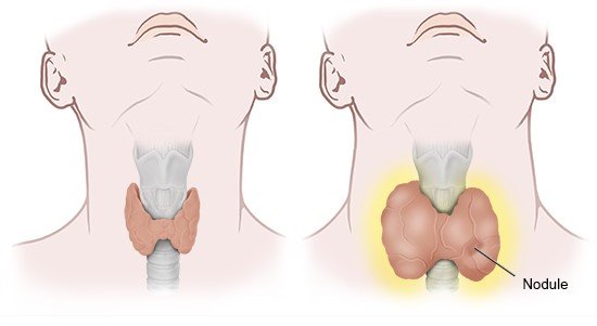 Illustration: The thyroid gland makes too many hormones