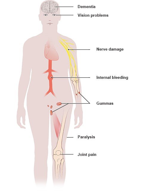 Illustration: Possible late complications of syphilis