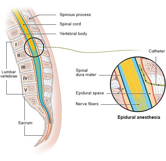 Illustration: Epidural anesthesia