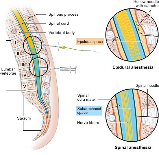 Illustration: Delivering pain-numbing drugs near to the spine: Epidural and spinal anesthesia