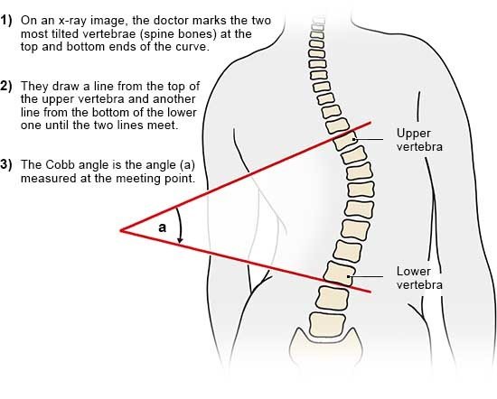 Illustration: How the Cobb angle is measured