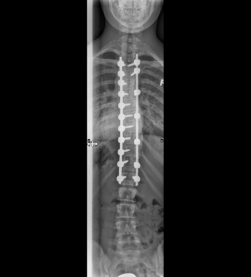 Illustration: X-ray image of a spine after spinal fusion surgery