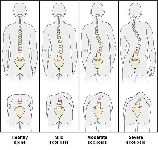 Illustration: Scoliosis: "Forward bend test" to look for a sideways curve in the spine