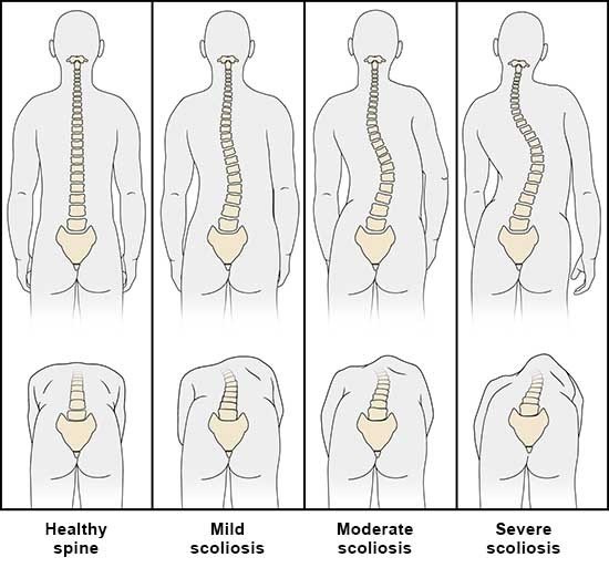 Illustration: Scoliosis: "Forward bend test" to look for a sideways curve in the thoracic spine