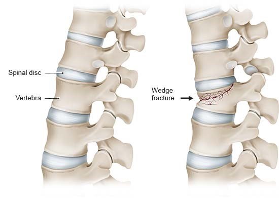 Illustration: Left – healthy spine; right – fractured vertebra