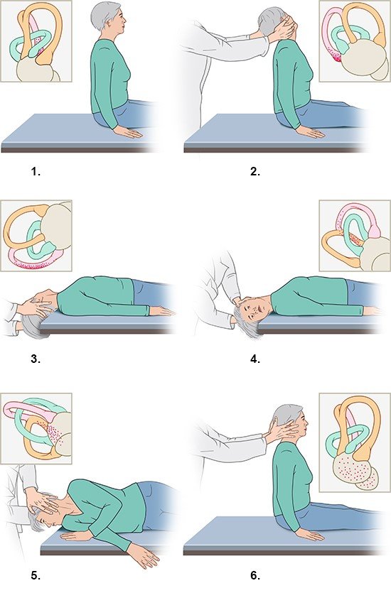 Illustration: Sequence of movements in the Epley maneuver for the treatment of BPPV caused by deposits in the left ear – as described in the article
