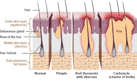 Illustration: Different types of hair follicle infections – as described in the information