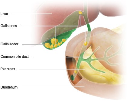 Illustration: Gallstones – as described in the article