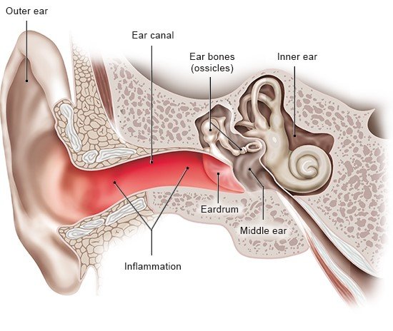 Illustration: Outer ear infection