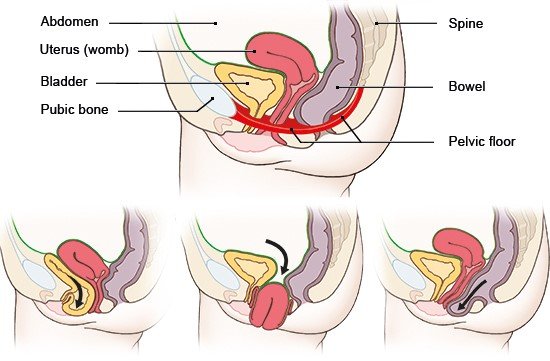 Illustration: Above: normal position of the organs in the abdomen; Below: left: bladder prolapse | middle: uterine prolapse | right: posterior vaginal prolapse (rectocele)