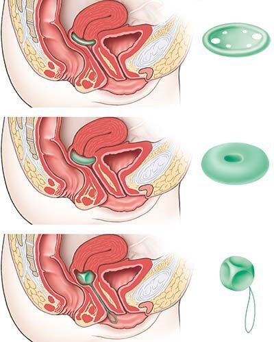 Illustration: From top to bottom: “saucer-shaped” ring pessary with support, ring pessary without support, and cube pessary.