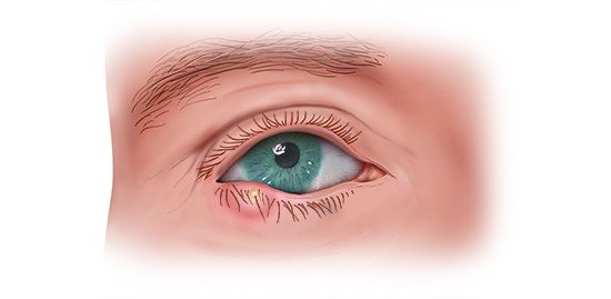 Illustration: Stye on the lower eyelid