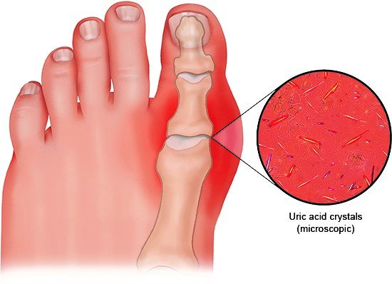 Illustration: In gout, tiny uric acid crystals build up in the body, mainly in the joints
