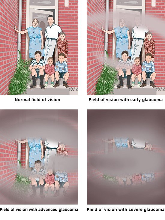Illustration: Possible effects on field of vision