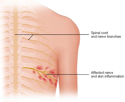 Illustration: Nerve infected by the virus, and inflamed area of skin