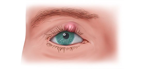 Illustration: Chalazion on the upper eyelid