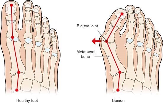 Illustration: Healthy foot and bunion – as described in the article