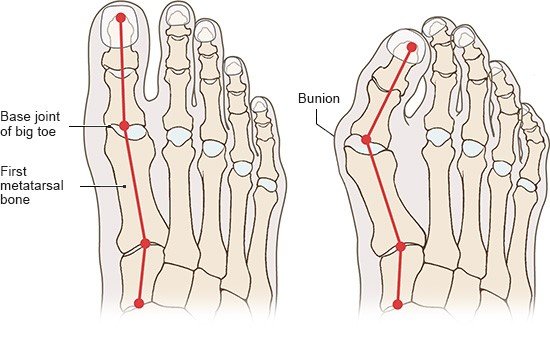 Illustration: Healthy foot and bunion – as described in the article