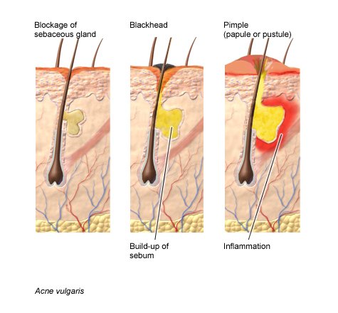 Development of a pimple