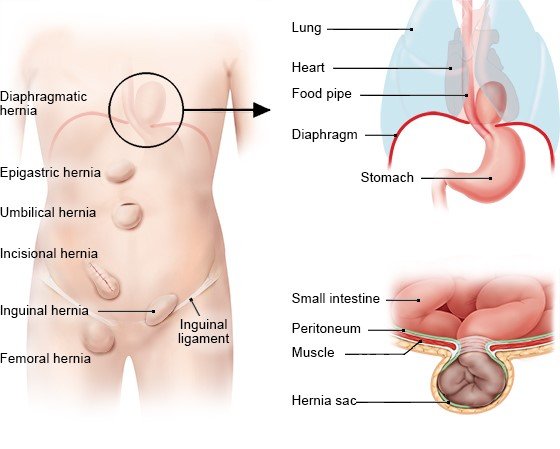 Illustration: The most common types of hernia