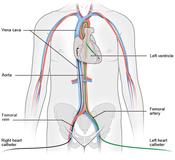 Illustration: Right and left heart catheterization, depicting the catheter reaching the heart with respective entry points