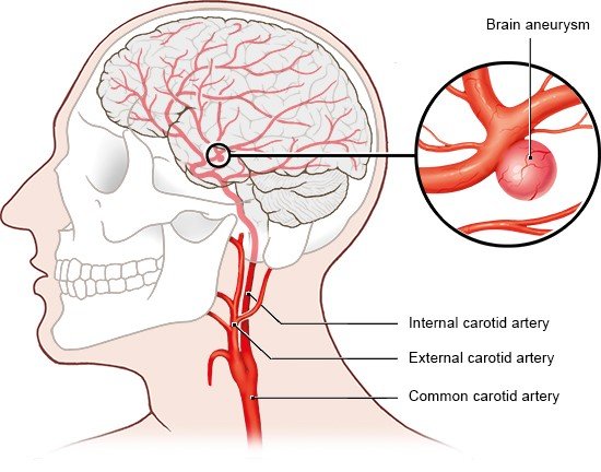 Illustration: Brain aneurysms are often located in the middle of the brain.