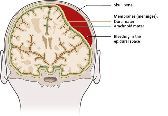 The illustration shows an epidural hemorrhage, where bleeding occurs in the space between the skull and the dura mater.