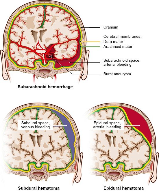 Illustration: Different types of bleeding in the brain