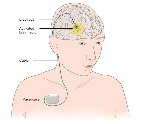 Illustration: In DBS, electrical signals are sent to certain areas of the brain (in this example: electrode on one side of the brain only)