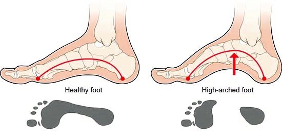 Illustration: Healthy foot and high-arched foot – as described in the article