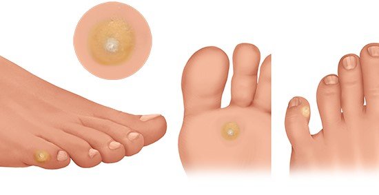 Illustration: Typical location and appearance of corns – as described in the article