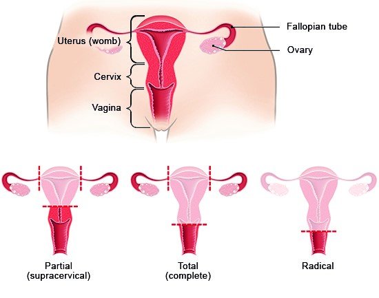 Illustration: Types of hysterectomy – as described in the article