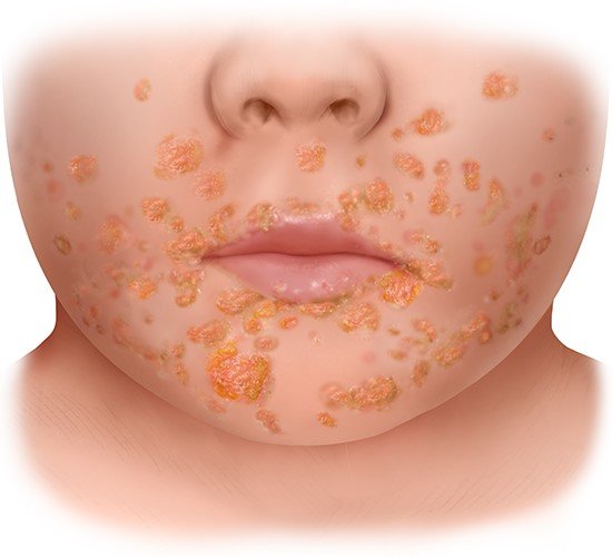 Illustration: Yellowish crusted-over impetigo blisters – as described in the article