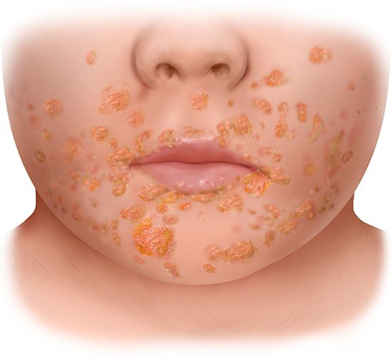 impetigo in children face